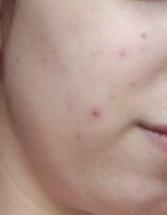 Vuelvo a Lullage: Lullage acneXpert Imagen