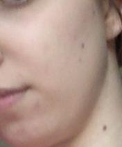 Vuelvo a Lullage: Lullage acneXpert Imagen