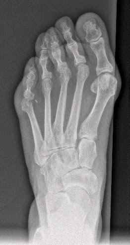 TRATAMIENTO QUIRURGICO DEL LLAMADO PIE TRIANGULAR TRATAMIENTO QUIRURGICO DEL LLAMADO PIE TRIANGULAR