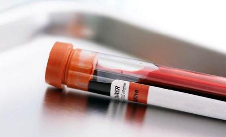 La depresión podría ser detectada en un análisis de sangre Analisis de sangre
