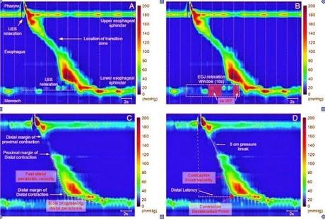 DIGESTIVO: Manométrica Esofágica de Alta resolución desplaza a Manometría convencional DIGESTIVO: Manométrica Esofágica de Alta resolución desplaza a Manometría convencional