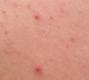 Remedios Caseros para eliminar el Acne, Barros y Espinillas acne