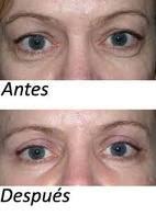 La Blefaroplastia