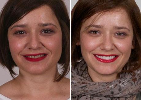 Tetraciclina, la culpable de mi mayor complejo (3ª parte) antes-después