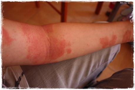 ¿Cómo controlar la dermatitis atópica? ¿Cómo controlar la dermatitis atópica?