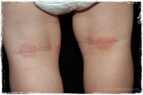 ¿Cómo controlar la dermatitis atópica? ¿Cómo controlar la dermatitis atópica?