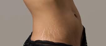 Reduce las estrías Reduce las estrías