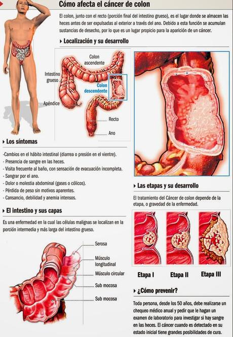 Cómo afecta el cáncer de colon #Infografía #Salud #Cáncer