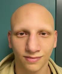 Novedoso Tratamiento para la Alopecia