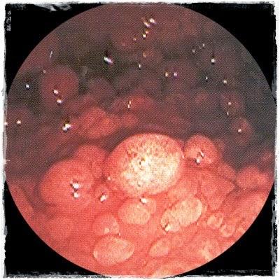 El síndrome de Peutz Jeghers El síndrome de Peutz Jeghers