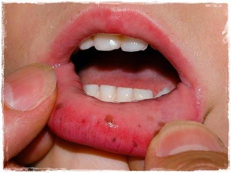 El síndrome de Peutz Jeghers El síndrome de Peutz Jeghers