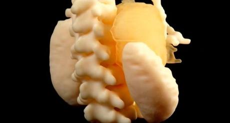 Extirpan en Barcelona un tumor inoperable a un niño gracias a una impresora 3D tumor inoperable
