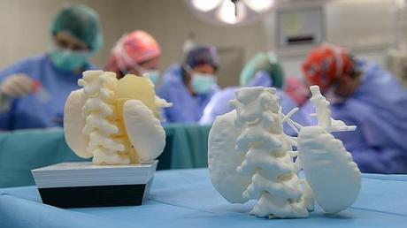 Extirpan en Barcelona un tumor inoperable a un niño gracias a una impresora 3D tumor inoperable