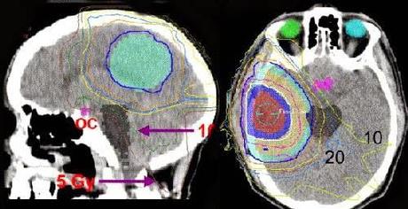 La radioterapia en el Cáncer del Sistema Nervioso Central La radioterapia en el Cáncer del Sistema Nervioso Central