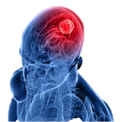 La radioterapia en el Cáncer del Sistema Nervioso Central La radioterapia en el Cáncer del Sistema Nervioso Central