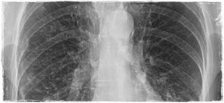Fibrosis quística Fibrosis quística