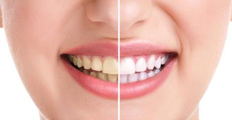 PROYECTO FIT 2014 OIL PULLING. CONSIGUE UNA SONRISA PERFECTA LRG Magazine - Oil Pulling