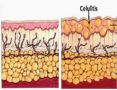 celulitis