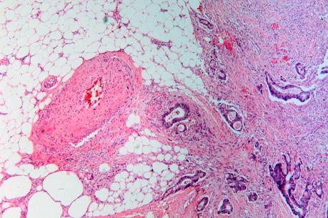 El análisis del microbioma mejora la detección del cáncer colorrectal invasivo Cancer colorectal