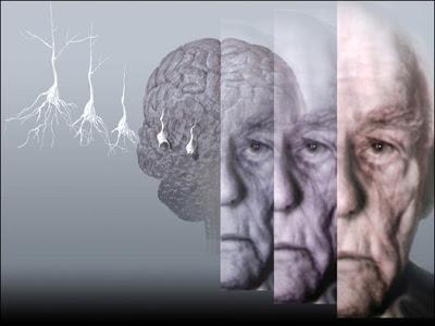 Los Accidentes Cerebrovasculares: Ictus y Derrame Cerebral (y II)