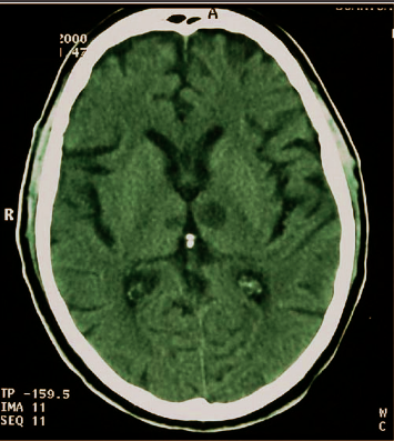 El Deterioro Cognitivo de Origen Vascular