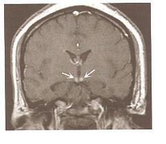 Alcoholismo y Daño Cerebral: El Síndrome de Korsakoff