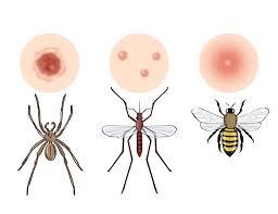 picaduras2 Reacciones alérgicas por picaduras de insectos en niños 