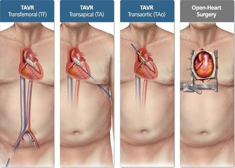 Tecnologia transcateter va dejando atras la cirugia a corazon abierto.