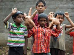 El insólito caso del  niño indio con manos gigantes