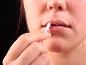 Tratamientos para el Herpes Labial y Genital tratamientos para el herpes labial y genital