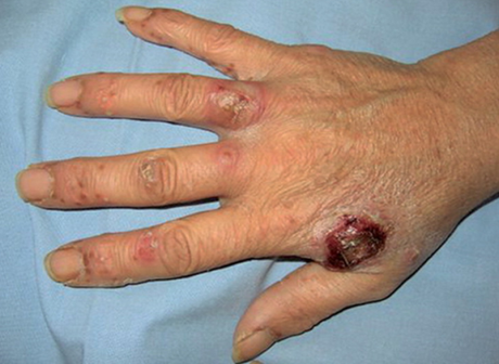 6 problemas de la piel relacionados con la Artritis Reumatoide artricenter