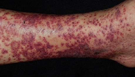 6 problemas de la piel relacionados con la Artritis Reumatoide artricenter