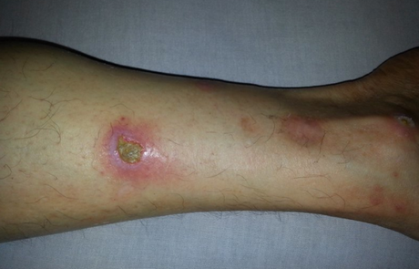 6 problemas de la piel relacionados con la Artritis Reumatoide artricenter