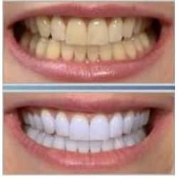 Tratamiento de blanqueamiento dental