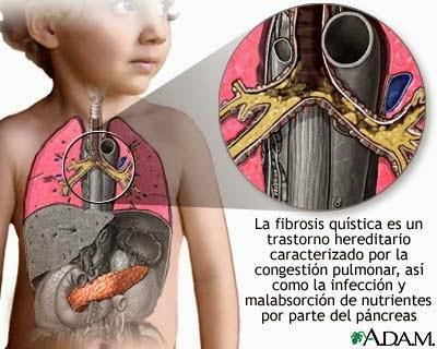 La fibrosis quística, ¿qué es y cómo tratarla? La fibrosis quística, ¿qué es y cómo tratarla?