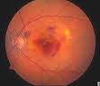 Tres de las cuatro enfermedades oftalmológicas que más casos de ceguera ocasionan en el mundo afectan a la retina