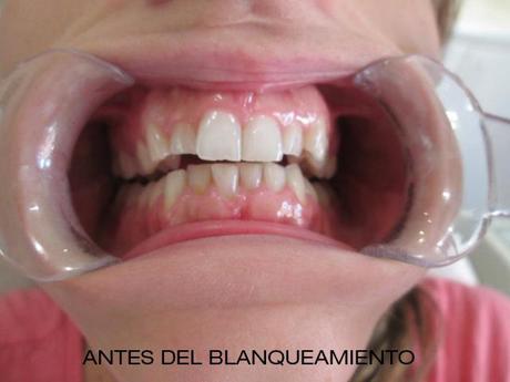 Una sonrisa impecable….By Clínica Mariana Sacoto Navía novia antes