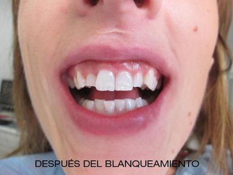 Una sonrisa impecable….By Clínica Mariana Sacoto Navía novia despues