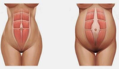 Diástasis abdominal Diástasis abdominal