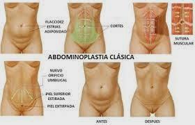 Diástasis abdominal Diástasis abdominal