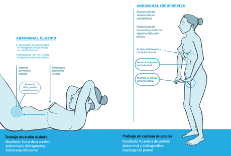 Diástasis abdominal Diástasis abdominal