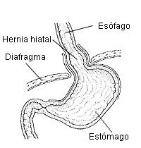 Cómo tratar la hernia de hiato Cómo tratar la hernia de hiato