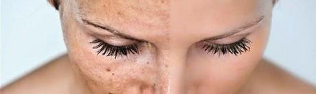 ¿POR QUÉ ES TAN DIFÍCIL DE TRATAR EL MELASMA?