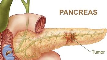 Una posible cura para el cáncer más mortífero, el cáncer de páncreas.