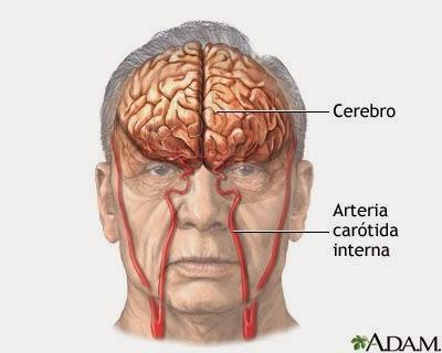 Noticias de accidentes cerebrovasculares