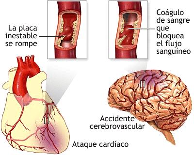 Tienen sentido las nuevas recomendaciones delas Estatinas