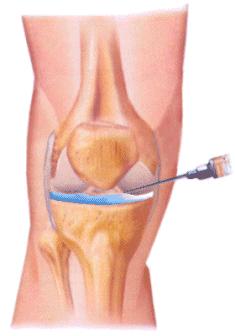 El uso del Ácido Hialurónico en la Osteoartritis artricenter