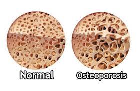 osteoporosis farmaceuticainmavinue