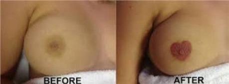 LAS 5 CIRUGÍAS ESTÉTICA MÁS RARAS DEL MUNDO Como un corazón 3