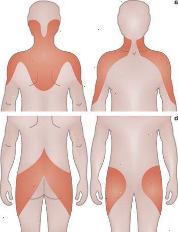 Arteritis de Células Grandes y Polimialgia reumática: posible causa de dolor de cabeza y hombros artricenter